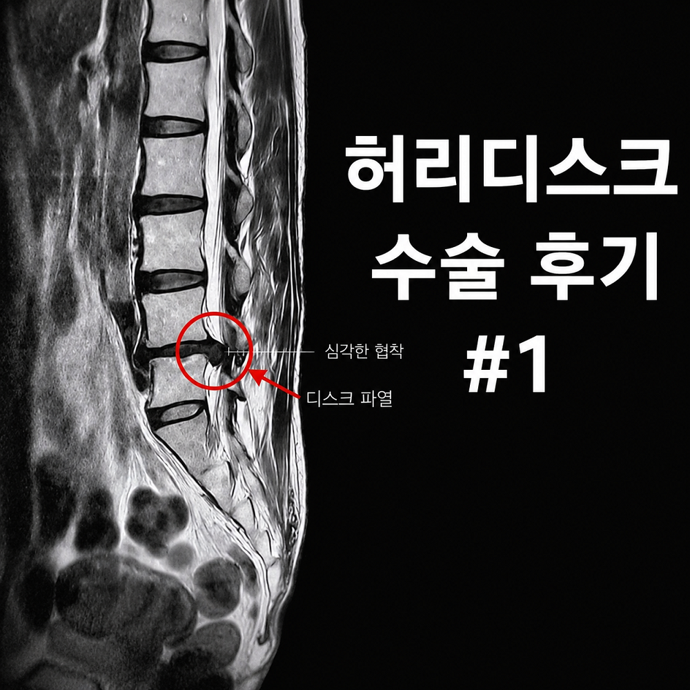 허리디스크 수술 실제경험