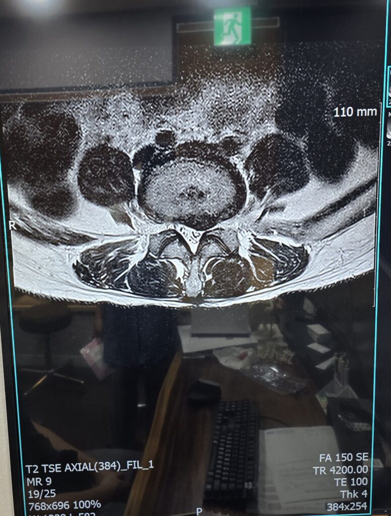 허리디스크 수술 전 MRI 단면 사진