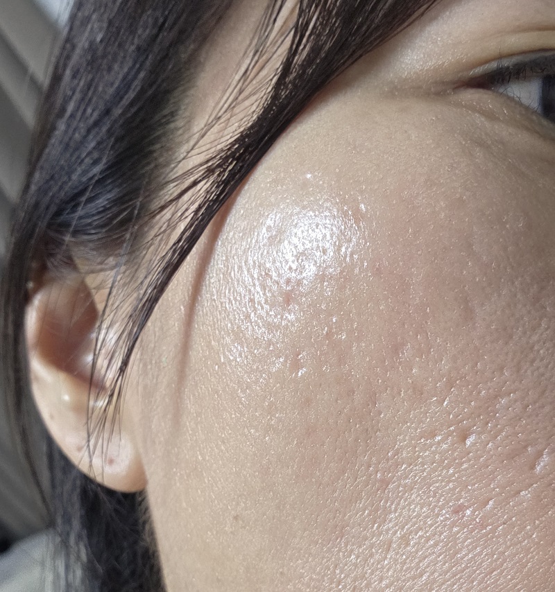 스킨부스터 부작용
